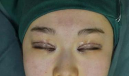 双眼皮埋线视频全过程,从术前准备到术后恢复
